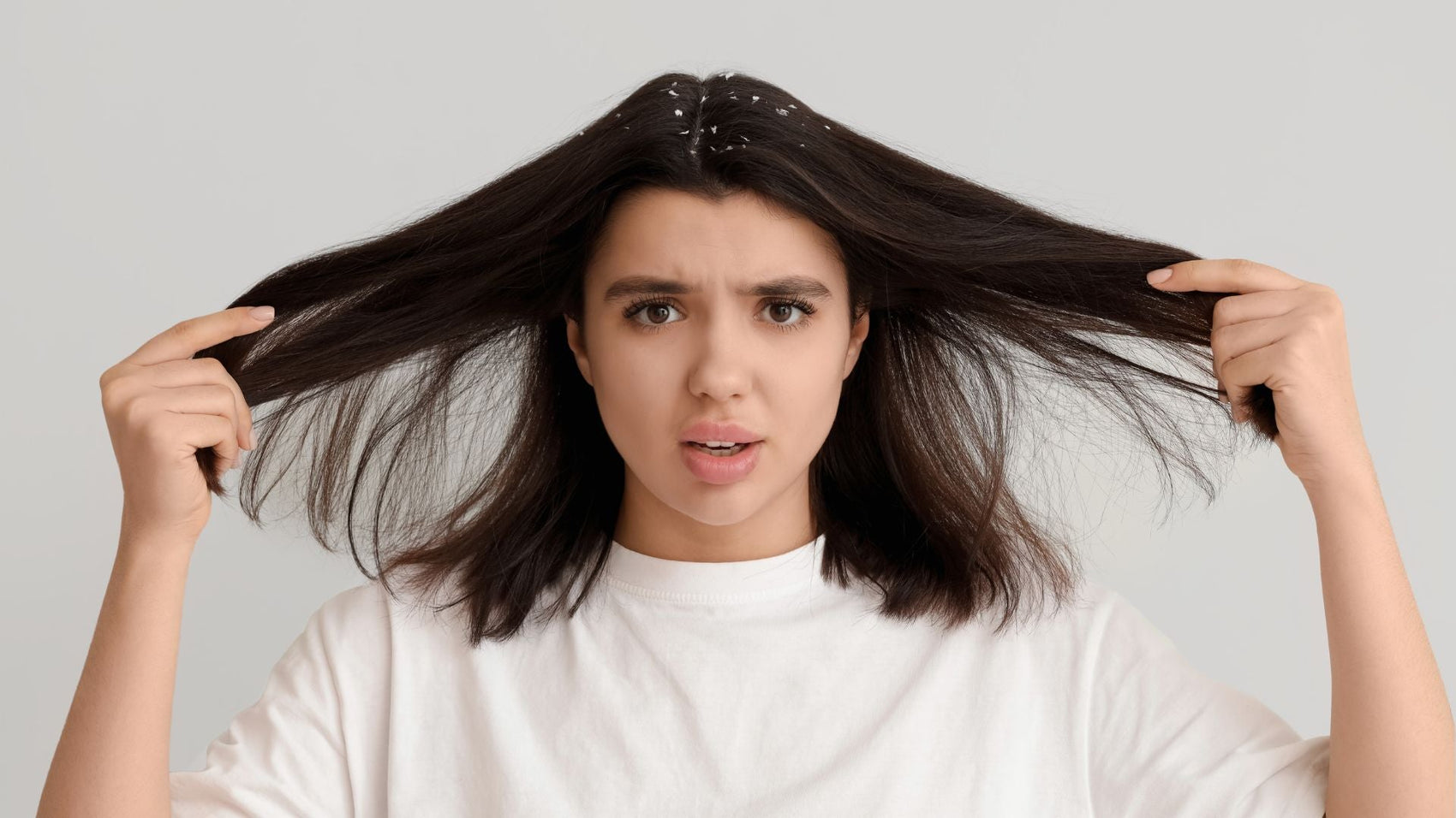 10 natural remedies for getting Rid of Dandruff